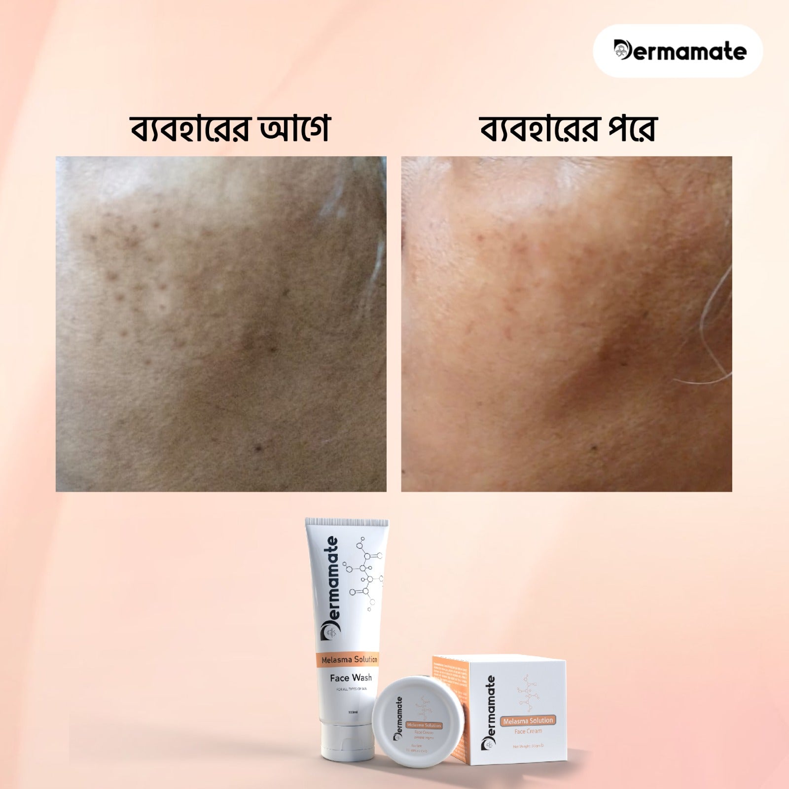 Melasma | Dermamate | Purple Care Limited